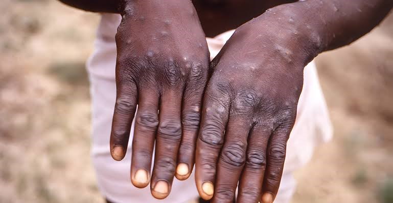 Africa Leads Global Mpox Cases – WHO